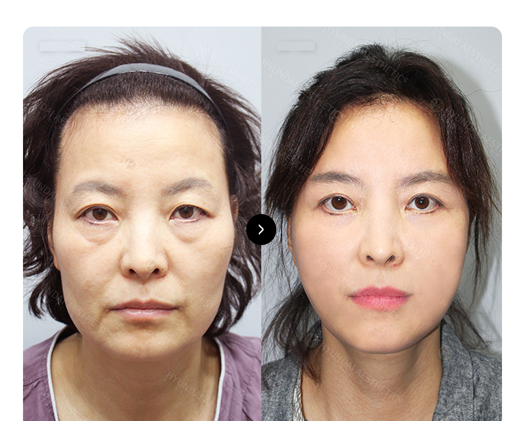 SMASフェイスリフト BEFORE & AFTER — 手術前後の比較