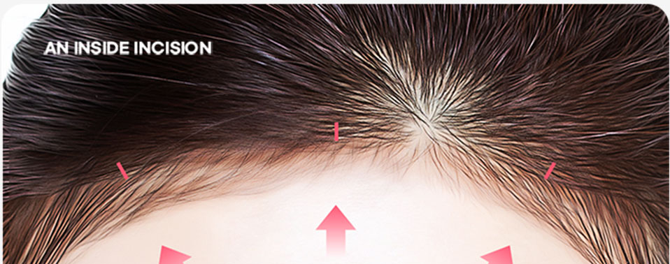 ヘアライン内側の切開部位を示す額のクローズアップ — AN INSIDE INCISION