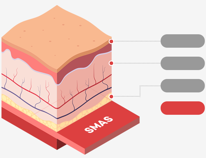 表皮層・真皮層・皮下脂肪層・SMAS層を示す皮膚断面イラスト