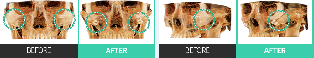 CASE 02 後上方再配置 — 正面・側面CT BEFORE / AFTER比較