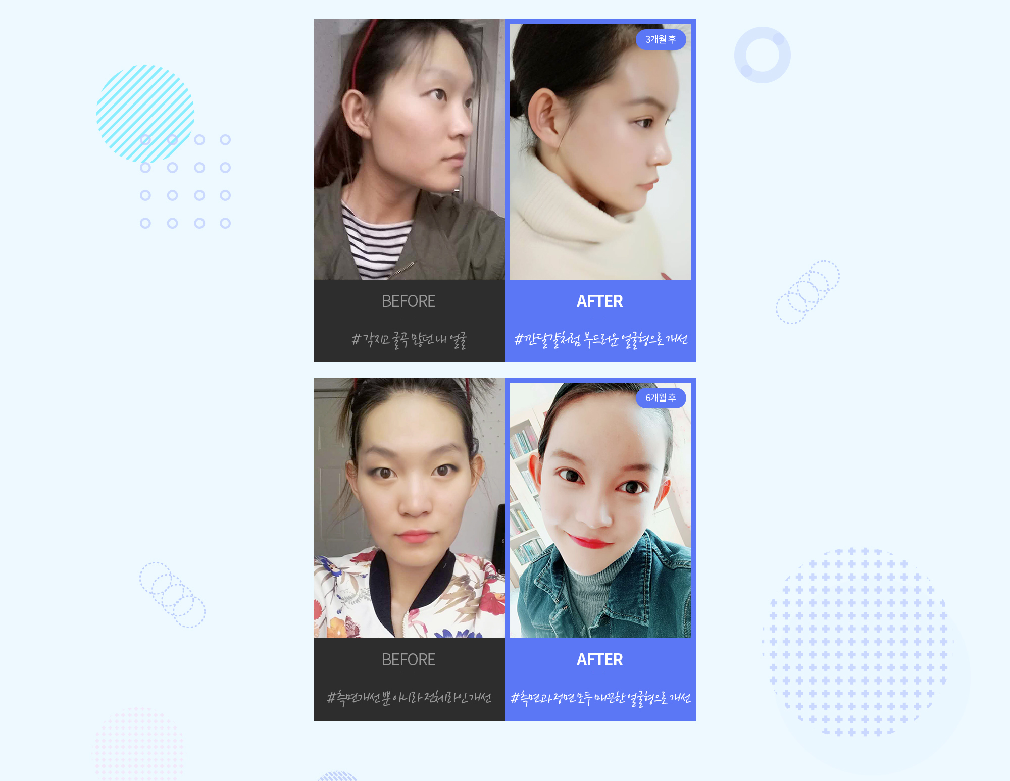 現代美学 頬骨縮小術 REAL ビフォーアフター写真 — CASE 1: 正面・側面 BEFORE/AFTER (#角張って凹凸が多かった私の顔 → #ゆで卵のようになめらかな顔型へ改善、6か月後). CASE 2: 正面・側面 BEFORE/AFTER (#側面改善だけでなく全体ライン改善 → #側面も正面もすっきりなめらかな顔型へ改善、6か月後).