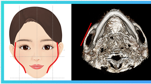 側頬骨突出型 — 頬骨図解 + CT