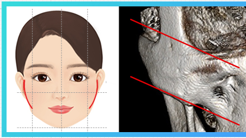 頬骨全体が広いタイプ — 頬骨図解 + CT