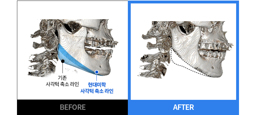 従来のエララインと 現代美学 エラ縮小ライン BEFORE / AFTER CT 比較