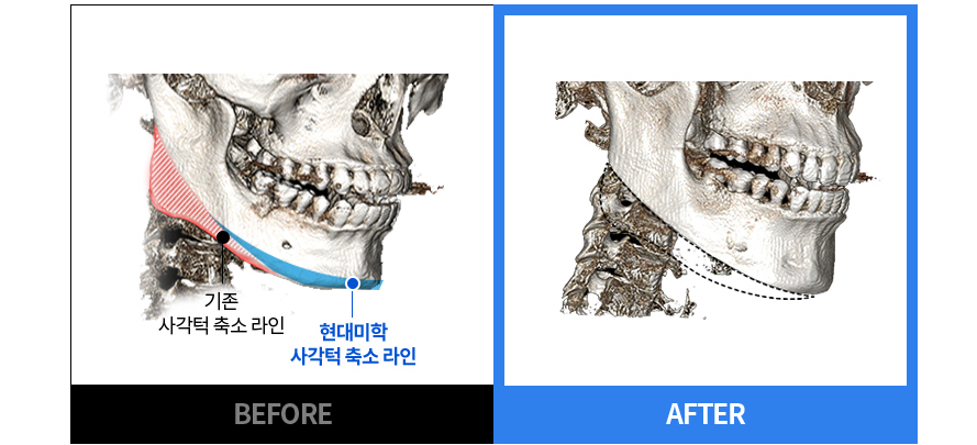 従来のエララインと 現代美学 エラ縮小ライン BEFORE / AFTER CT 比較