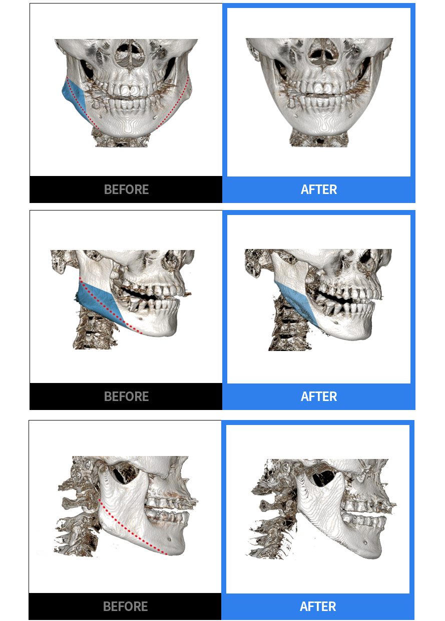 エラ縮小前後の正面・側面 BEFORE / AFTER CT 比較