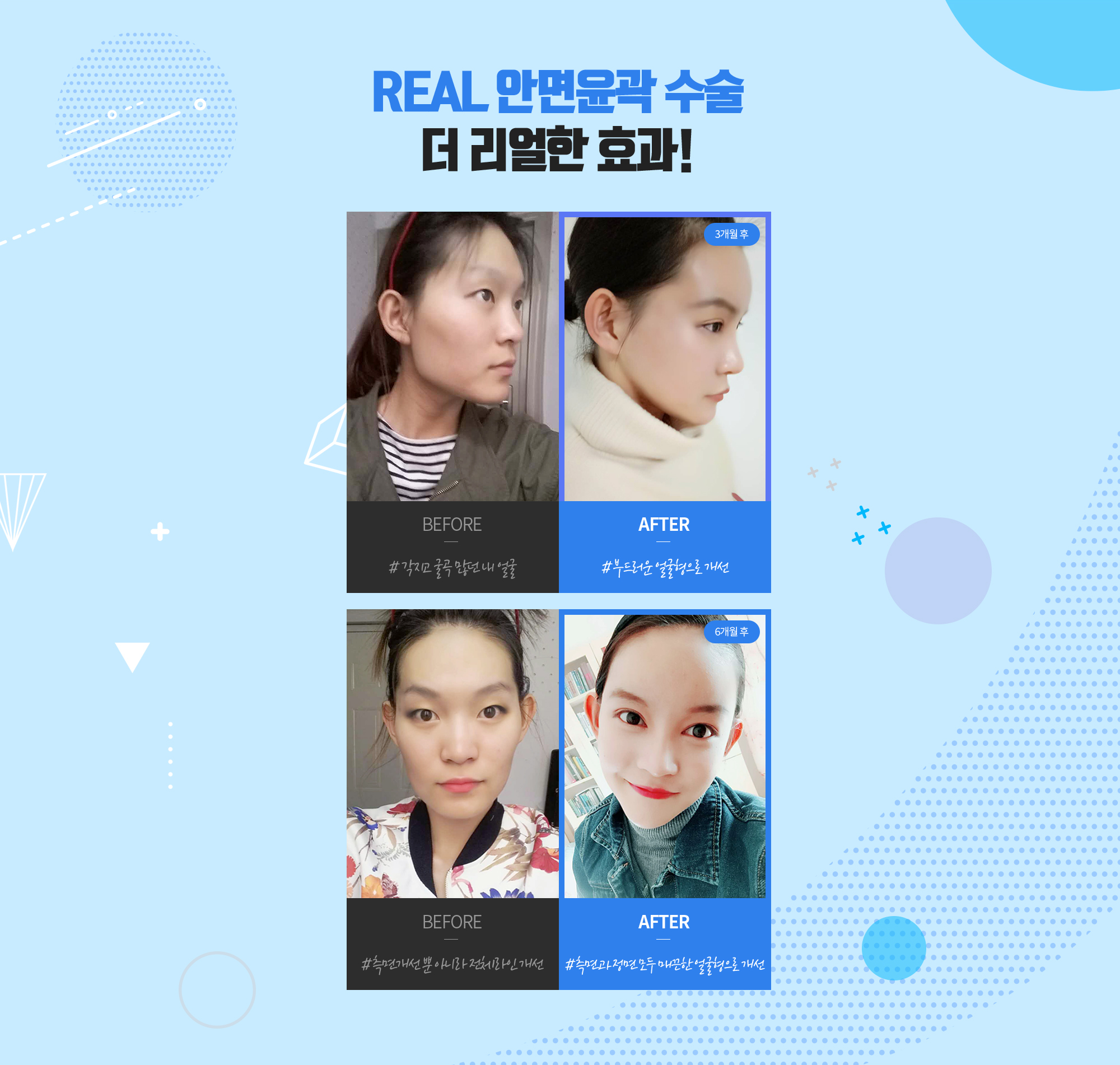 REAL 顔面輪郭手術、よりリアルな効果! — 現代美学 エラ縮小術 REAL 症例写真