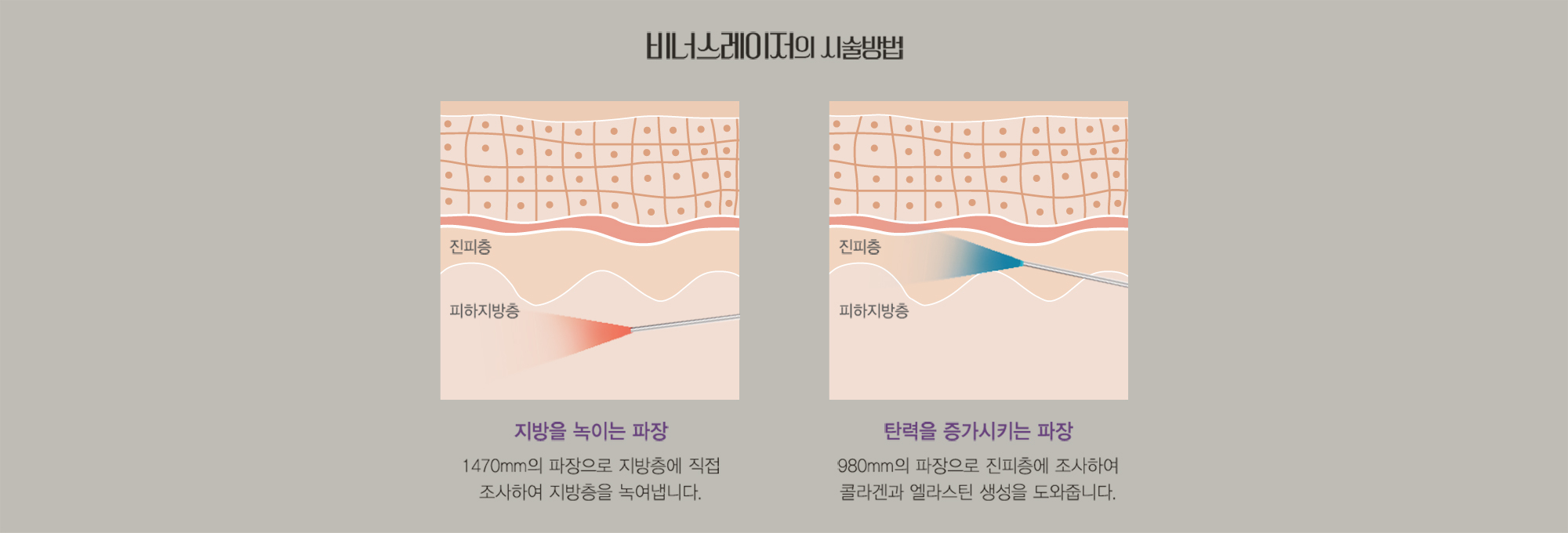 ヴィーナスレーザーの施術方法 — 真皮層・皮下脂肪層の断面図と2つの波長説明