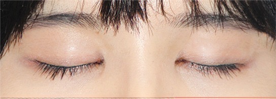 テンミニッツ自然癒着 手術前後比較写真 2