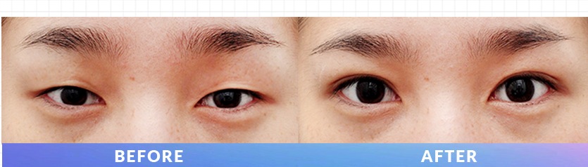 テンミニッツ自然癒着の前後の目元を比較したInstagram投稿画像
