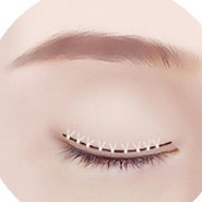 切開二重手術 STEP 03 固定・縫合段階イラスト