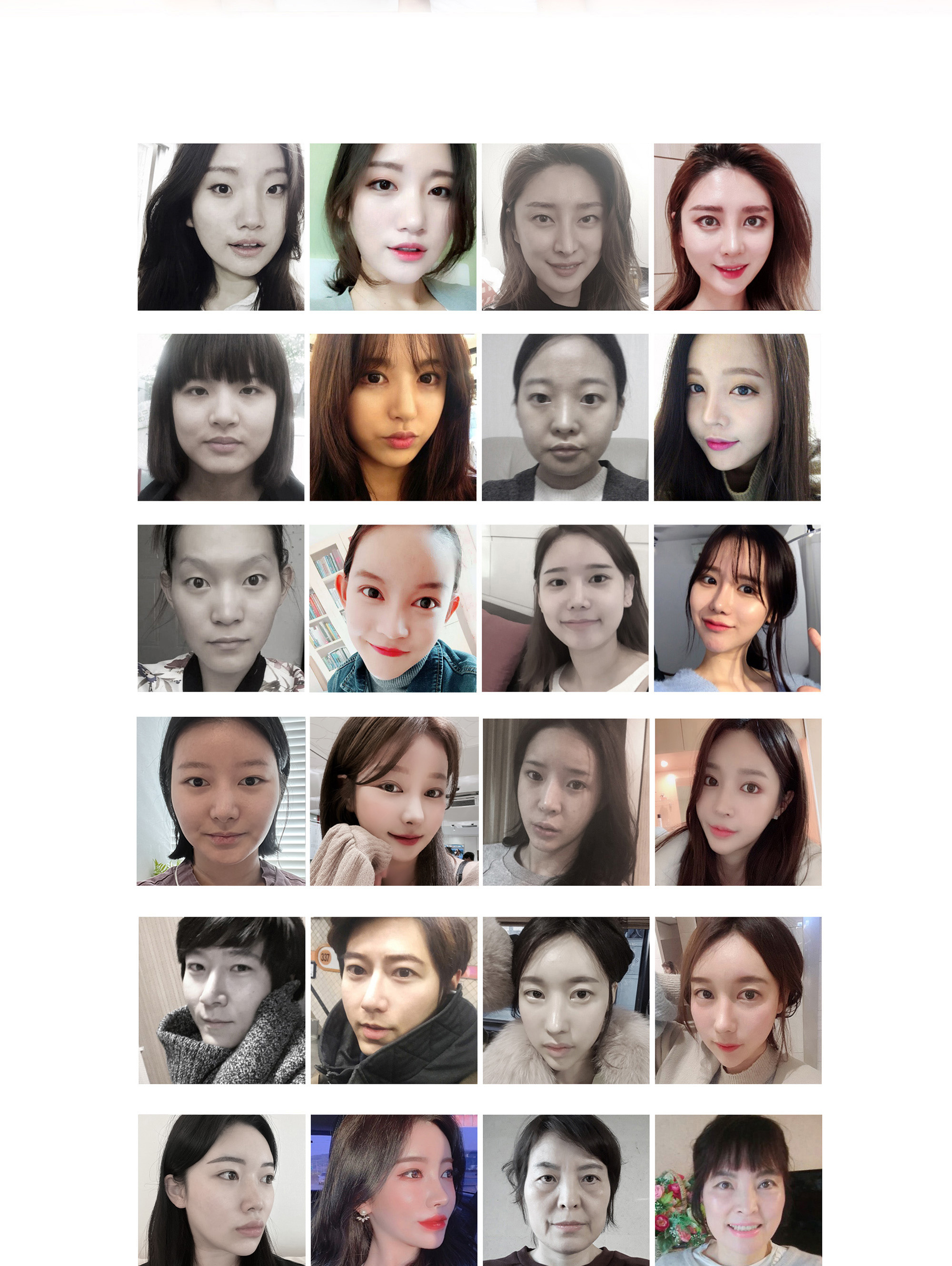 唇非対称矯正術 Before & After 症例