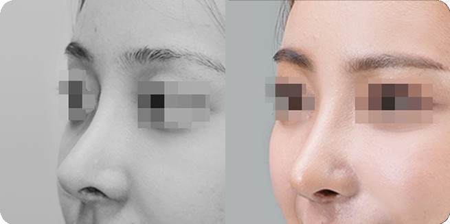 無プロテーゼ鼻整形 前後側面比較 1 (BEFORE / AFTER 3MONTH)
