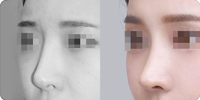 無プロテーゼ鼻整形 前後側面比較 2 (BEFORE / AFTER 3MONTH)