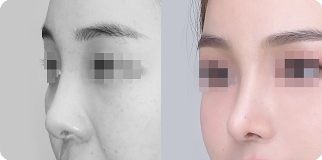 無プロテーゼ鼻整形 前後側面比較 3 (BEFORE / AFTER 3MONTH)
